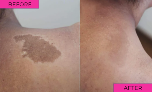 before-after-2